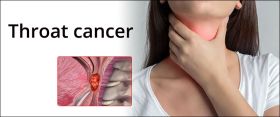 Throat cancer
