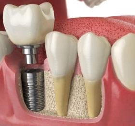 Dental Implants