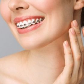 Dental Braces Duabi