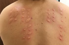 Allergy Testing