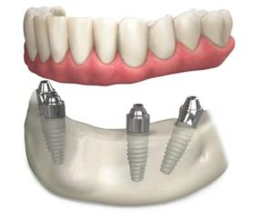 Dental Implants Melbourne