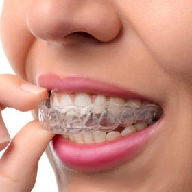 Aligners in Dubai