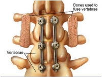 Spin Surgery