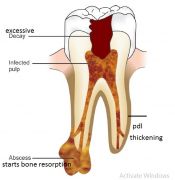 root canal treatment