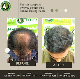 Scalp Micropigmentation