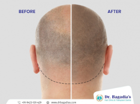 Hair Transplant Clinic