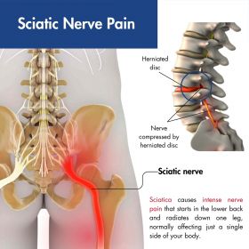 Sciatica Treatment - Madison, WI