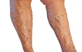 Varicose Veins Treatment