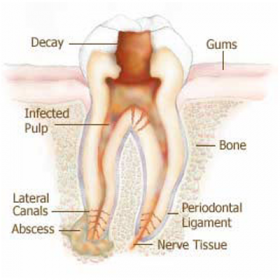 Root Canal Treatment