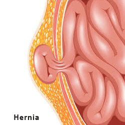 Hernia Surgery