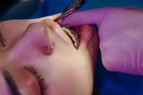 Teen Orthodontics