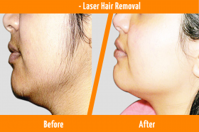 Laser Hair Removal