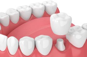 Dental Crowns
