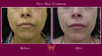 Skin Treatments in Pune