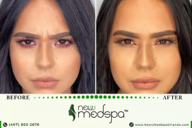 Botox