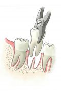 ­Dental Extraction