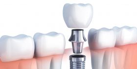 Dental implants in Ahmedabad