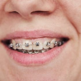 Teeth Braces in Dubai