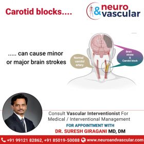 cerebral angiogram