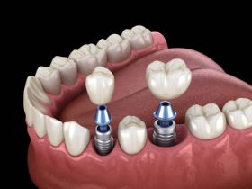 Dental Implants in Gurgaon