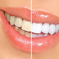 Instant Tooth Whitening