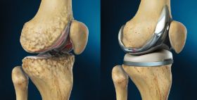 Joint replacement surgery, Treatment
