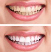 Teeth Whitening in Srilanka - Zenith Dentistry