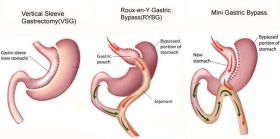 Bariatric Surgery