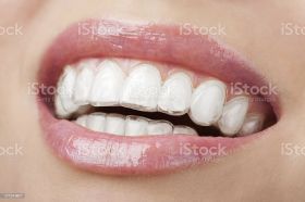 Invisible Aligners