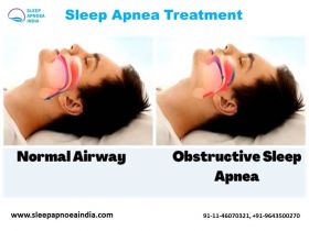 Sleep Apnea Test