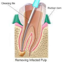 Root Canal Treatment Specialist In Chennai|Denteaz