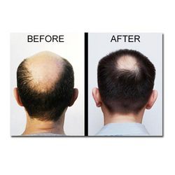 Hair Transplantation 