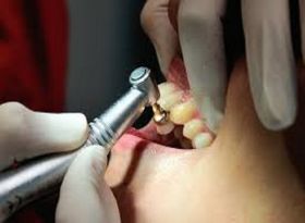 TOOTH EXTRACTION TREATMENT