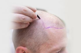 Hair Transplantation in Hyderabad Cosmetic 360