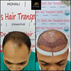 Hair Transplant Clinic in Chandigarh