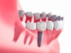 Dental-Implant Restorations