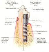 dental implant