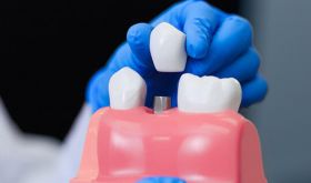 Dental Implants