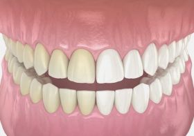 Zoom Teeth Whitening in Stamford, CT