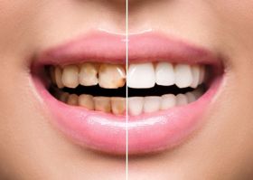 Teeth Whitening Services In Agra