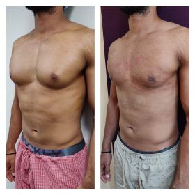 Gynecomastia surgery