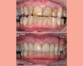 Restorations (Tooth Filling)