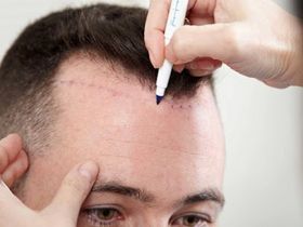 Hair Transplant