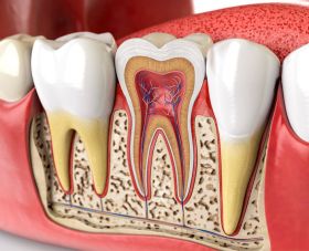 Root Canals