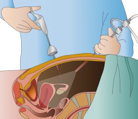 Laparoscopic 