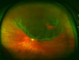 Retinal Detachment Surgery – NYC Eye Doctors