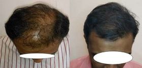 Hair Transplant in Mumbai