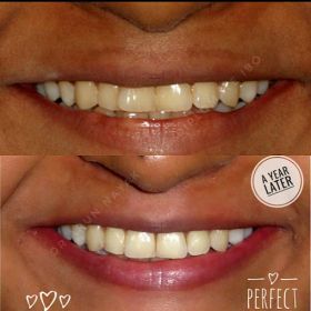 Teeth Whitening & Bleaching Treatment