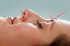 Acupuncture Face Lift