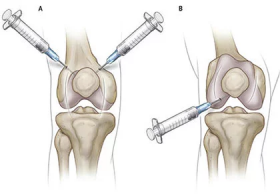 Knee Injections for Osteoarthritis - Astoria, NY